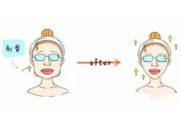 广州削骨医院哪家好