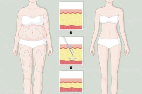 飞瘦脂雕和康美脂雕哪个好？读懂“抽脂”与“体雕”的区别不踩坑