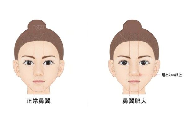 鼻翼缩小哪种医美方式比较好？