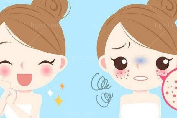 雀斑激光一次多少钱