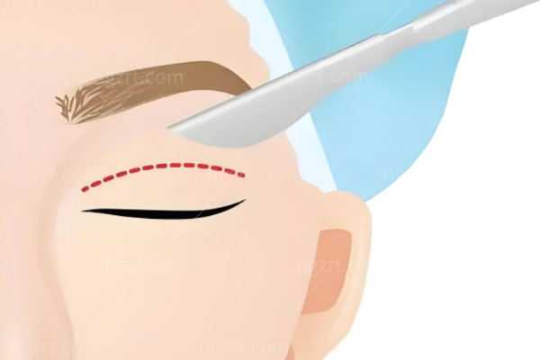 上海双眼皮罗施医生在哪个医院