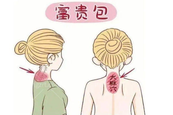 沈阳杏林整形能做富贵包手术吗?推荐张宇夫做微创富贵包吸脂手术技术好价格合理