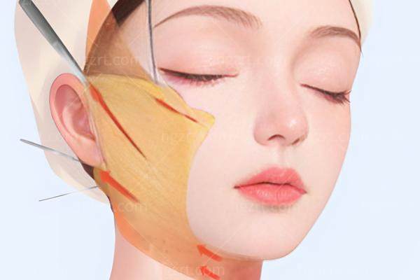 袁强博士拉皮的三大关键亮点