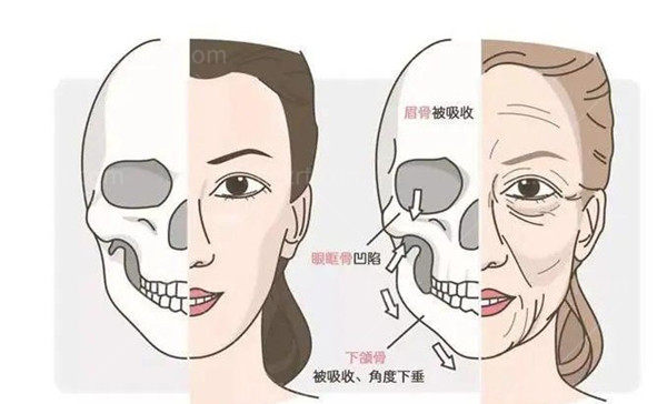 坦白局：轮廓术后的钛板钛钉一定要取出吗？做完轮廓手术后什么情况下需要取出钛钉？