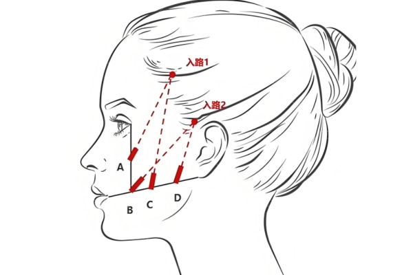 2026年轮廓固定针需要多少钱