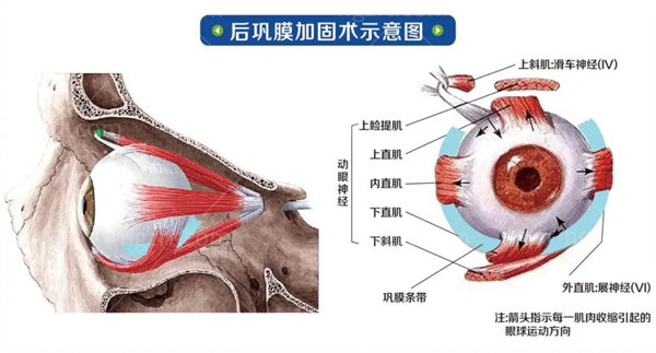 北京后巩膜加固术医生
