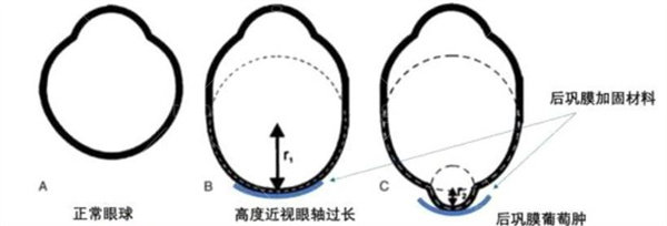 北京后巩膜加固术医生