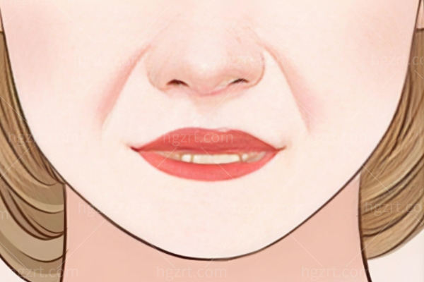 鼻基底填充和法令纹填充的区别:从原理/成效/人群多个方面分析