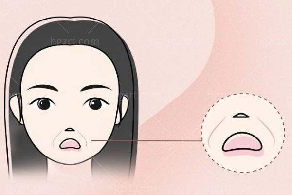 鼻基底填充和法令纹填充的区别