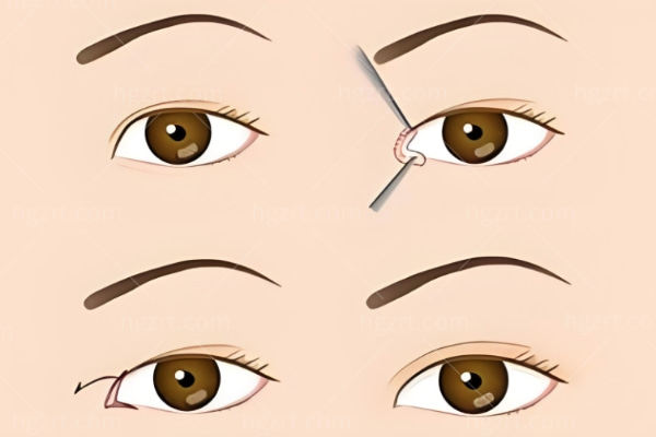 实锤了!上海杜园园双眼皮修复口碑好!专攻高难度双眼皮失败修复成功实例多,口碑评价较好！