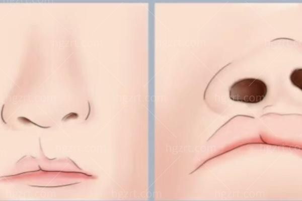 隐形唇裂内切好还是外切好?