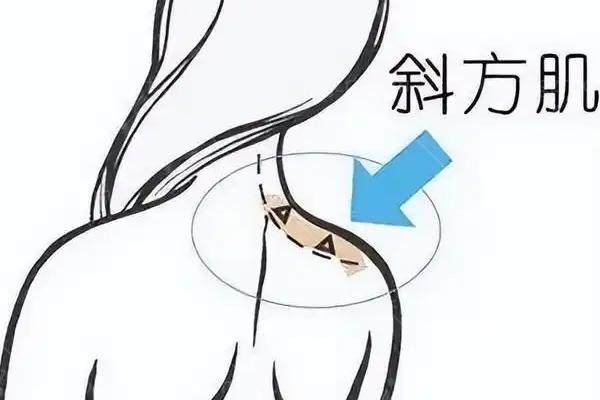 肩膀注射完瘦肩成效怎么样