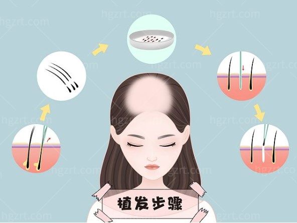 植发后头发能管多久