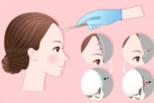 韩国丰颅顶手术用的是骨水泥吗?一问说清其过程、危害及注意事项