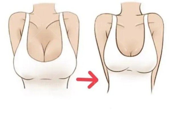 魔滴假体有芯片和无芯片哪个好？