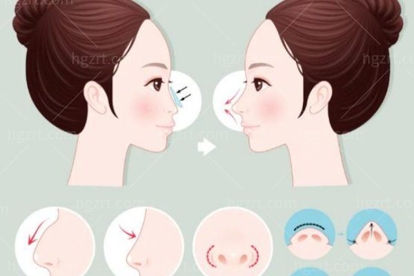液态骨雕隆鼻修复期多久