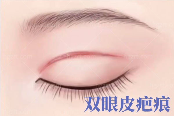 双眼皮失败 (1).jpg