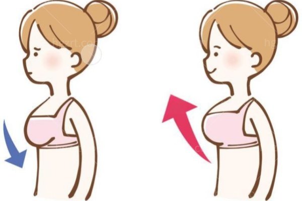 隆胸假体怎么选