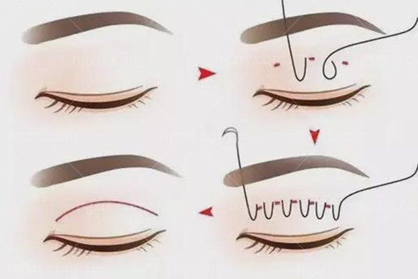 上海张园园和许炎龙双眼皮修复哪个好