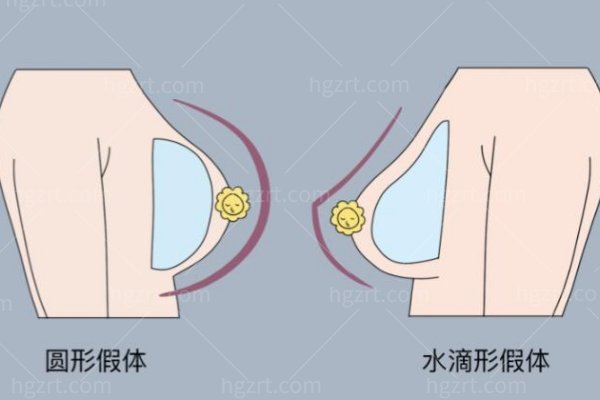 硅胶假体隆胸坚持时间