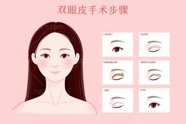 佀同帅和朱迪双眼皮选哪个