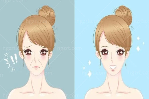 法令纹:我emo了!是填玻尿酸还是做提拉,这是个问题