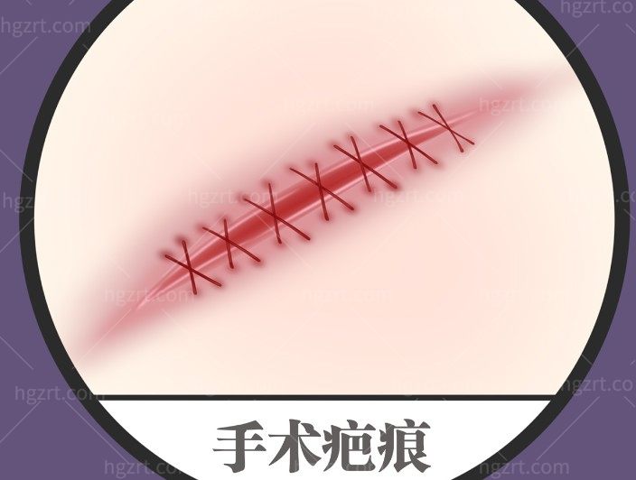 2026上海疤痕修复收费标准一览，这两家医院祛疤技术靠谱价格透明闭眼入