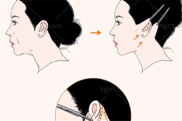上海安禾美阁黄军令医生做拉皮多少钱