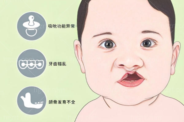 杭州兔唇修复好的医院推荐