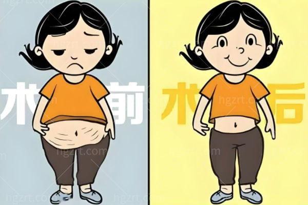 生完孩子肚子收不回去？腹壁成形术是个啥？是拉皮手术吗？适合什么样的人？