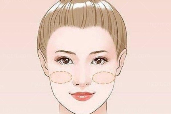 苹果肌适合打哪种玻尿酸