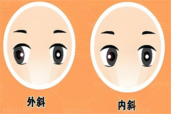 斜视不是长大就好