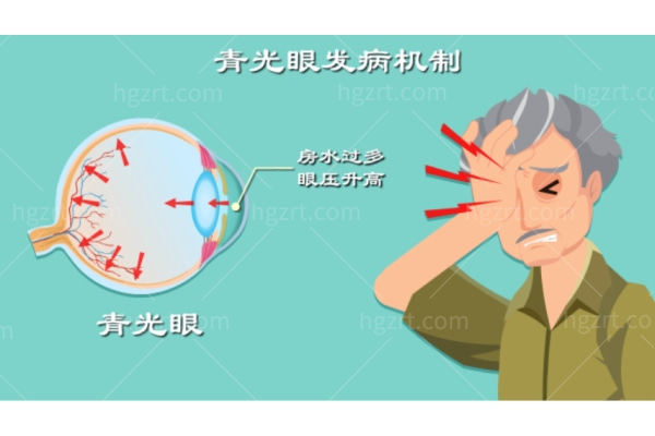青光眼是视力小偷,早期没症状