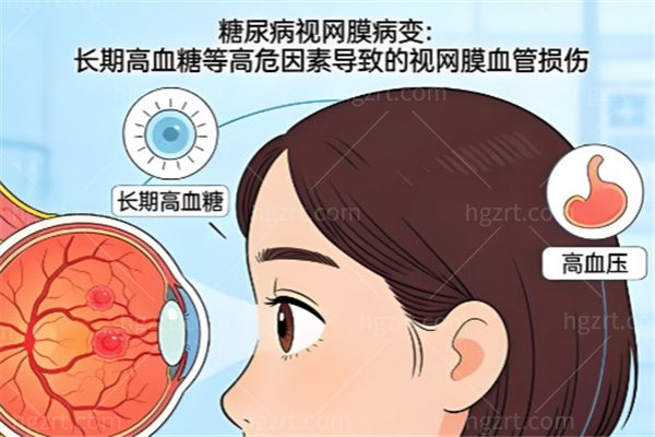 糖尿病病人为什么每年一定要查眼底