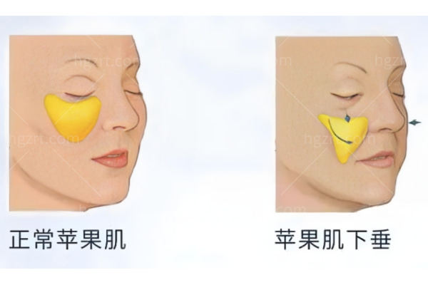 为什么有些人的苹果肌笑起来像两块石头