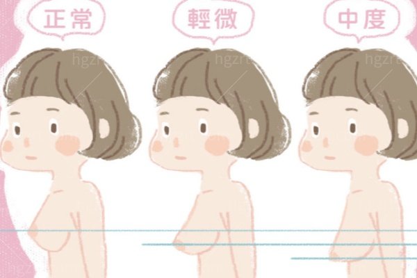 隆胸翻车别慌！成都熊猛（专治包膜挛缩）和汪灏（矫正假体移位）到底该找谁？