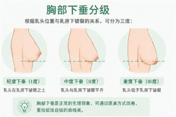 胸部下垂只做隆胸有用吗?乳房提升术和假体隆胸的区别