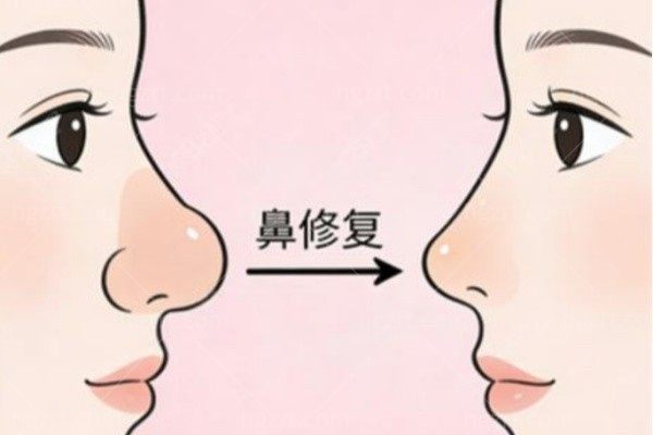 冰月岚的骨雕可以做鼻基底吗？