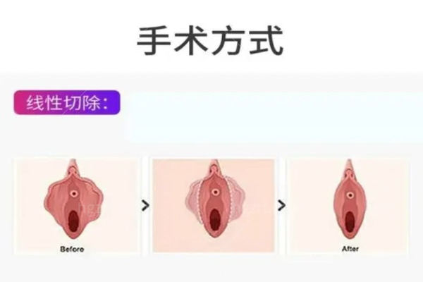 小阴唇不对称自己不知道