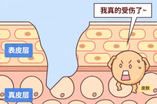 光子嫩肤适合哪些皮肤问题？色沉泛红毛孔要分开判断