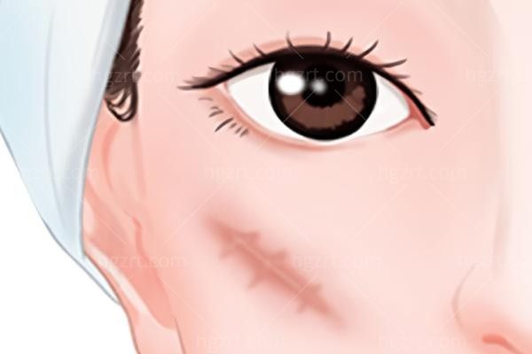剖腹产疤痕增生怎么去除？