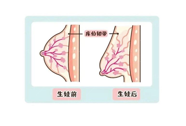 奥美定隆胸取出后怎么修复