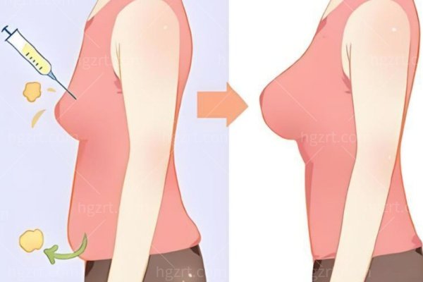 身体塑形胸部项目配图