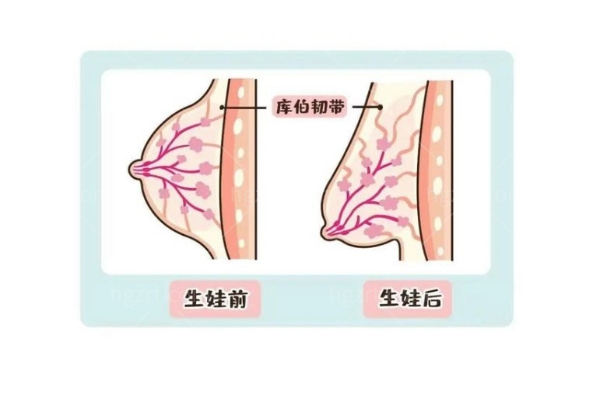 胸部下垂只做隆胸有用吗？乳房提升术和假体隆胸的区别