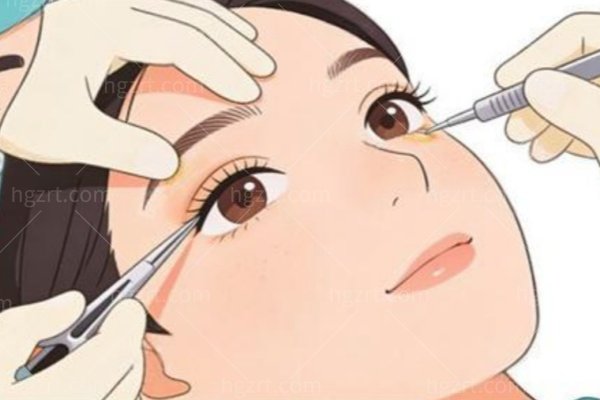 奉劝想填泪沟的姐妹：别贪便宜打低价玻尿酸，修复的钱够你再打三次！