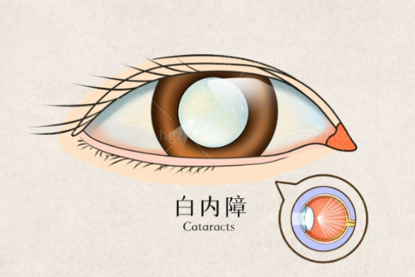 白内障 (1).jpg