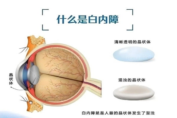 白内障 (5).jpg