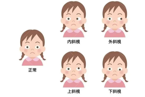 斜视远近眼位和眼球运动检查图