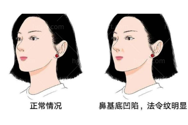 深圳陈瑞红做面中凹陷和玻尿酸隆鼻怎么样？想垫鼻先看鼻基底这一步
