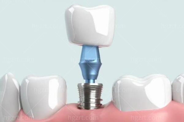 奥齿泰与登腾种植体详细对比：材质、型号、使用寿命、价格，看完分清韩系两大主流植体